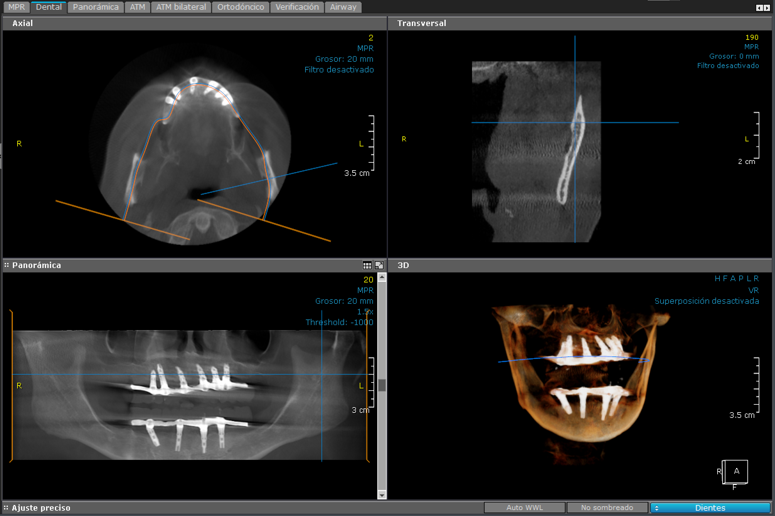 3D - Bimaxilar