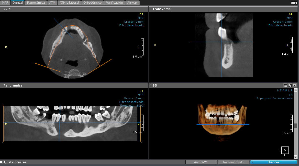 3D - Maxilar Inferior